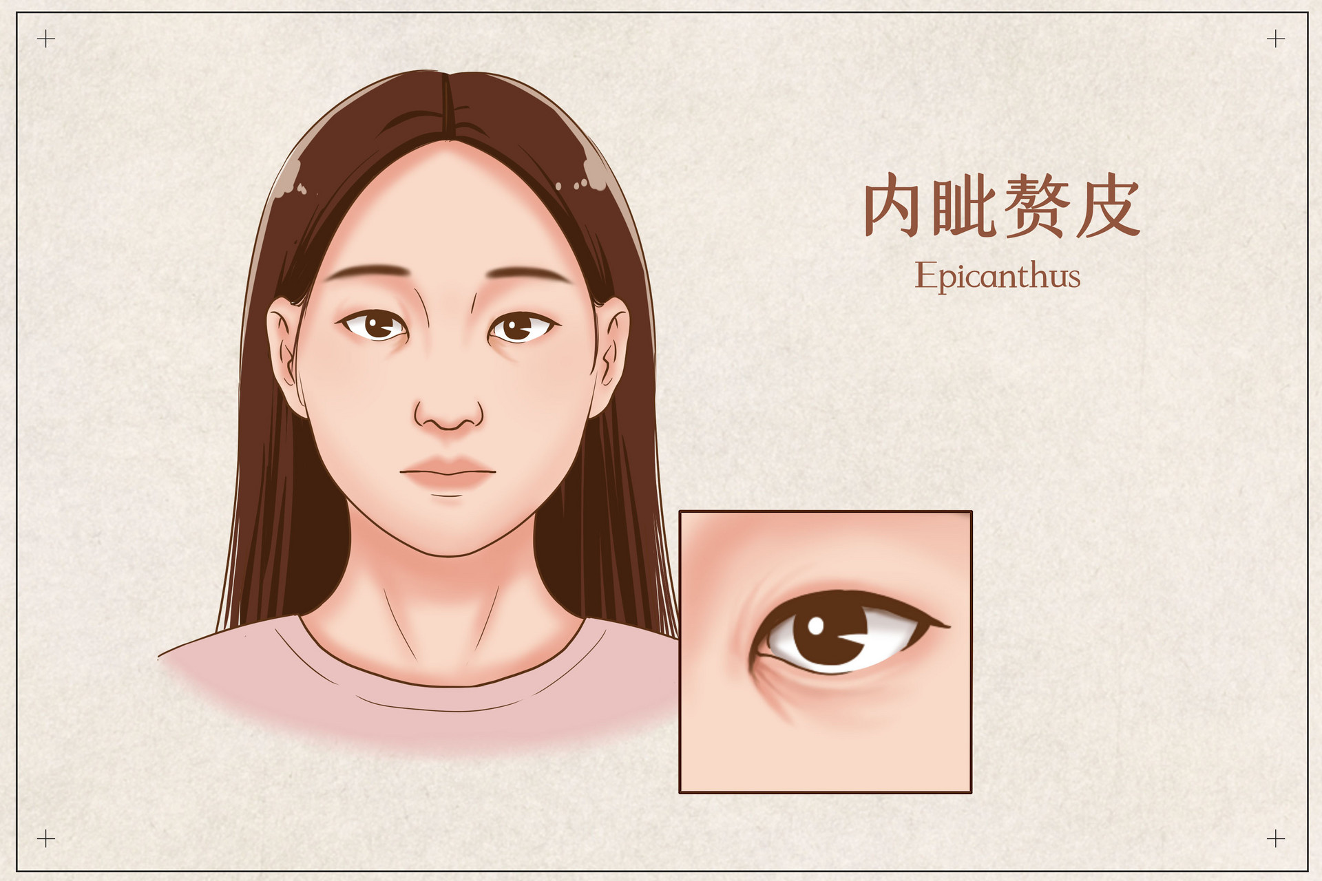 内眦赘皮